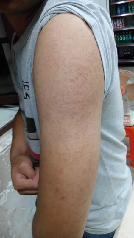 请问医生我手臂上这个是什么东西?有什么治