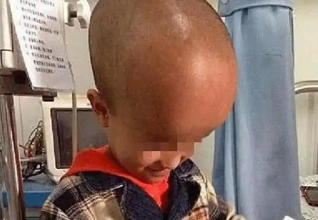 都说大头症宝宝颅骨突出有真实图片吗