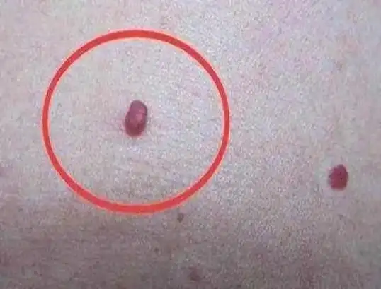 身体莫名出现小红点当心这种疾病