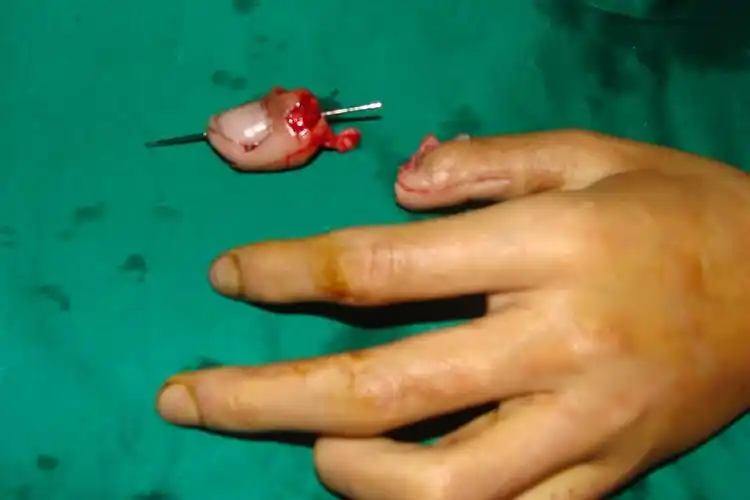 手指再造 - 好大夫在线