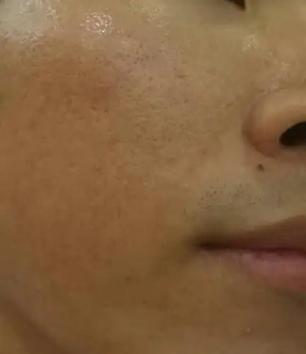 脸部超级油性,毛孔堵塞,有发炎症状,已有几年了,有没有什么秘方或者