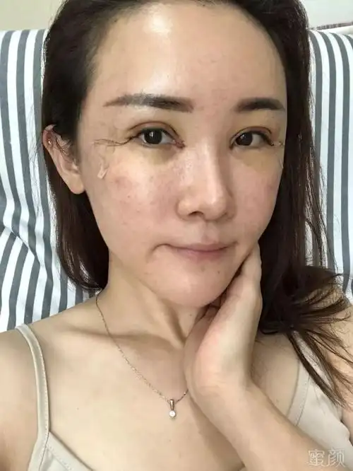 「自体脂肪填充 眼综合—日记分享」如果你变好看了.