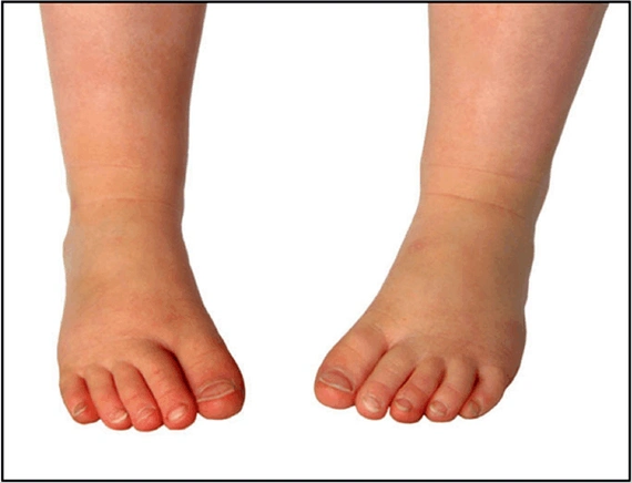 马蹄内翻足是一种先天性的畸形,主要是由于先天性足部肌力不平衡,内翻