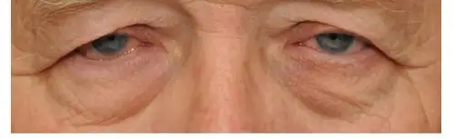 年纪轻轻眼皮却松弛了?