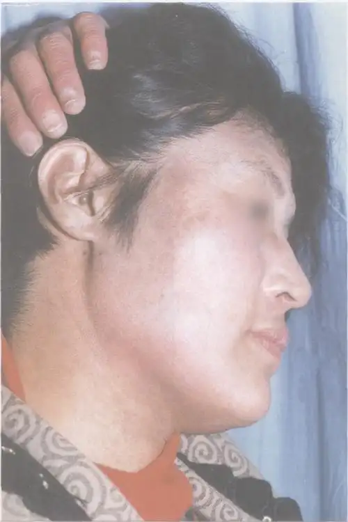 瑞尔氏黑变病-常见皮肤病彩色图谱-医学