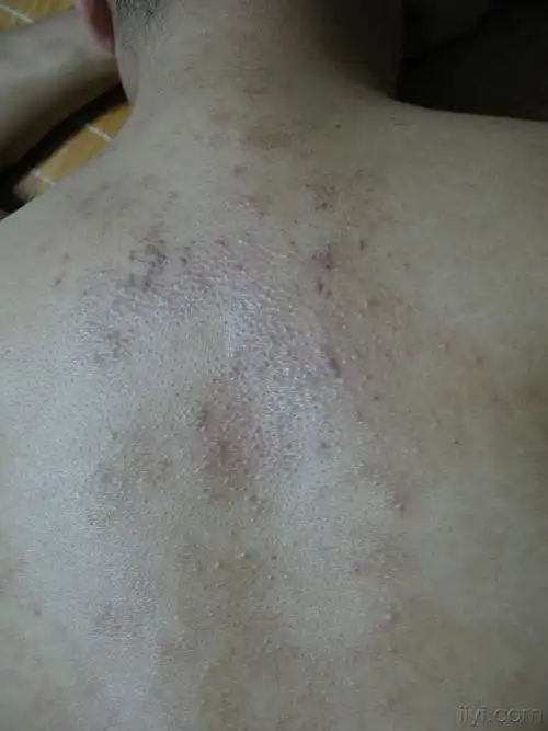 皮肤及性传播疾病讨论版 - 爱爱医医学论坛