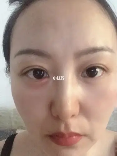 昨天左眼下眼角突然肿了起来今天更严重了摸起来又硬又疼像是一个大