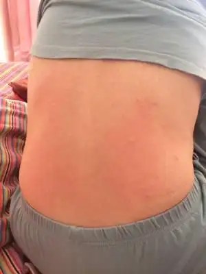 怀孕18周,浑身痒,一挠就红,还有包