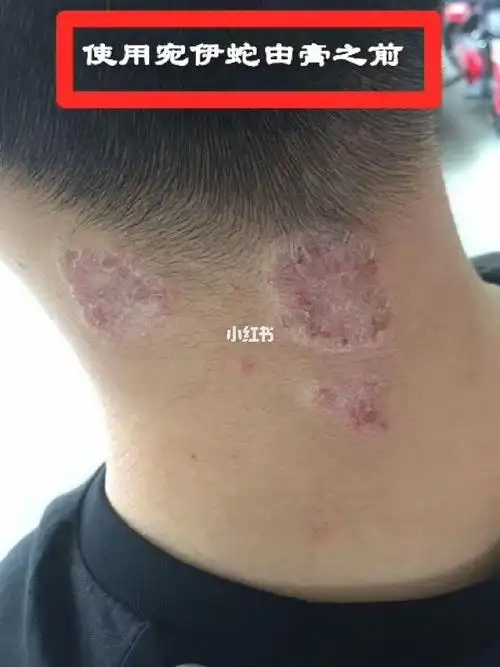 脖子上的癣,用蛇由膏涂抹,一天三至五次,恢复的挺好,现还在继续巩固中