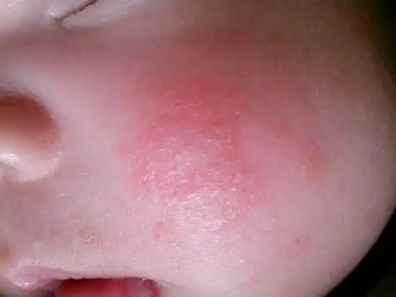一个2岁宝宝身上长满了密密麻麻的红疹子!