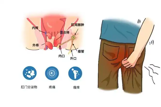 肛门瘙痒伴有分泌物肛门疼痛是肛门癌的典型症状之一,一开始可能不太