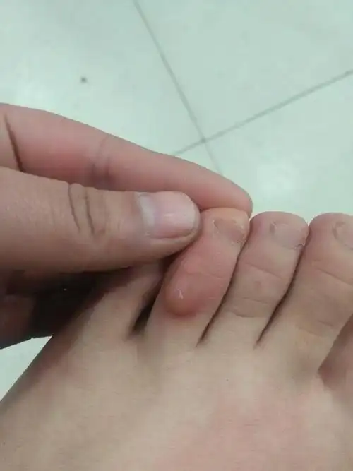 这脚上的是穿高跟鞋磨出来的老茧吗 不疼989898