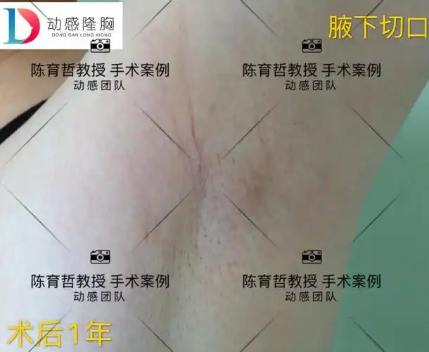 这是术后一年,腋下切口疤痕恢复的情况!你还能找到切口在哪里吗?