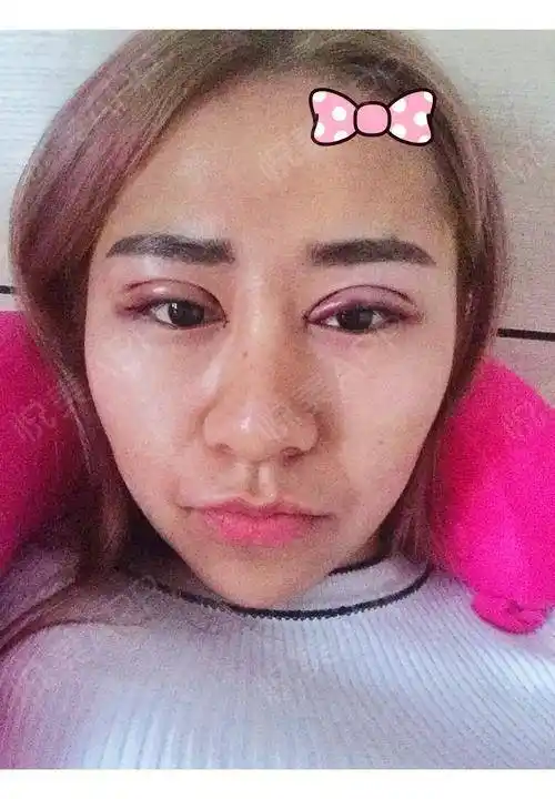 做的韩式三点双眼皮加开眼角,第一天,肿的好厉害啊