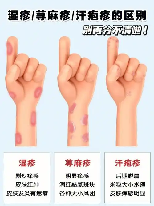 教你一张图弄懂湿疹荨麻疹汗疱疹的区别