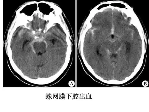 影像总结头颅ct基本知识与常见病变