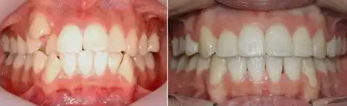 虎牙矫正前后对比图