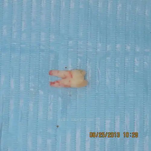 上颌第一双尖牙3牙根--屈晓兵