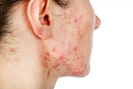 皮肤问题结节囊肿性痤疮皮肤年轻女孩皮肤问题结节囊肿性痤疮皮肤年轻