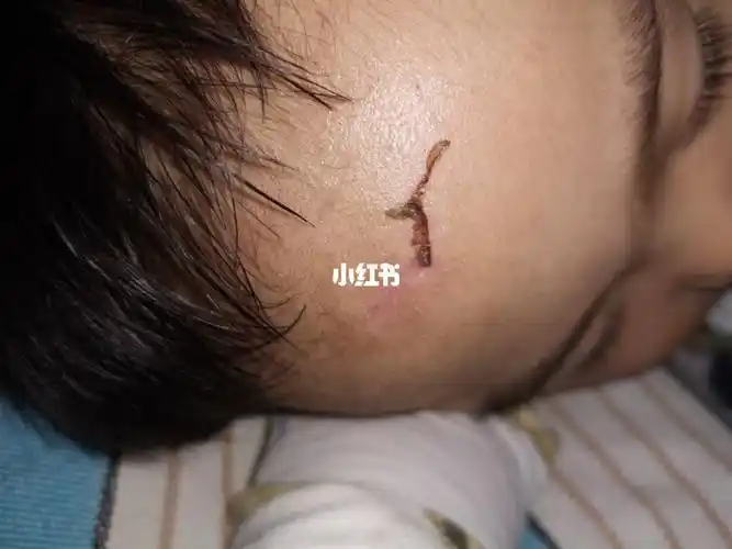 暖宝仔仔抗疤第五天