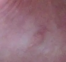 包皮上长了一个东西无明显感觉里边有白点图片