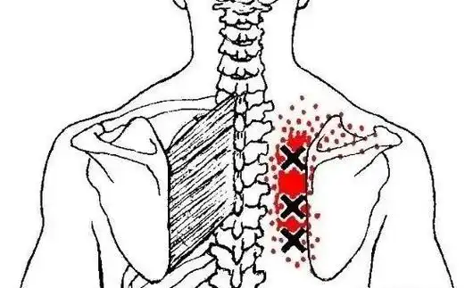 肩胛骨内侧缘痛的简单分析