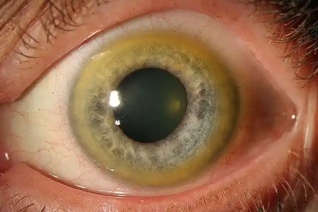 眼球变黄跟肾有什么关系吗(眼睛6个小毛病)(8)