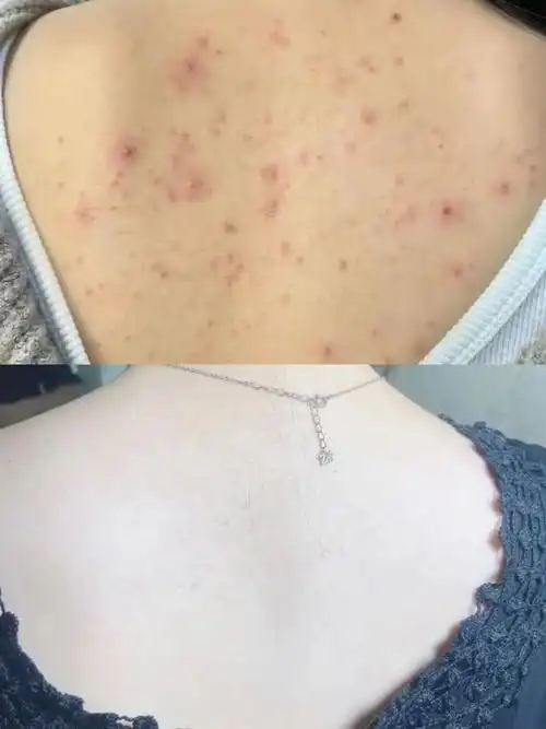 祛痘|除螨|痘痘|螨虫|皮肤科医生_网易订阅