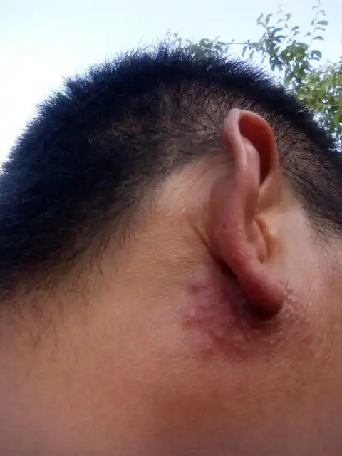 耳根旁长的像红疱疹,一碰很疼