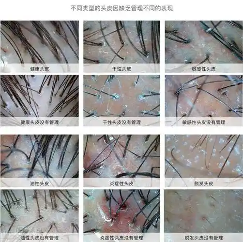 头皮保养的重要性