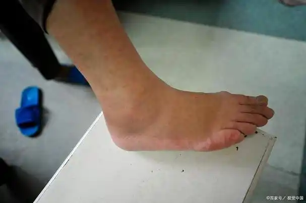 水肿后查出肾病,心凉半截,医生:别胡思乱想,积极面对走出阴霾