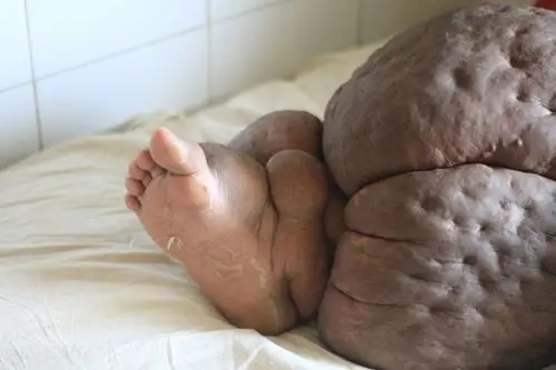 右腿肿成57公斤象腿 生完女儿怪病缠孟加拉妇18年