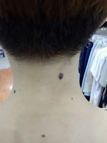 我的颈部后面长了一颗大痣,周围有很多小痣,这是不是恶性黑色素瘤?
