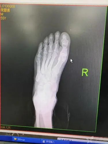 趾骨骨折克氏针内固定手术