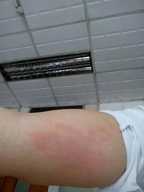 全身特别痒 一会又消了 ,痒的时候,皮肤很热的,这是怎么病