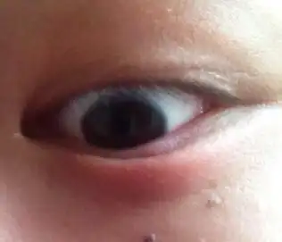 眼睛下面肿了,昨天开始的,怎么回事,怎么办