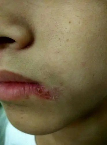 嘴角烂成这样,前幅图是昨天的第二幅是今天的,这是什么原因造成的和缺