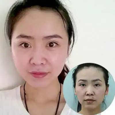 自体脂肪丰额头前后对比照