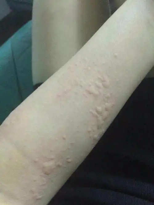 夏季天气炎热,荨麻疹反复发作处于高发期,五个措施早做防范!