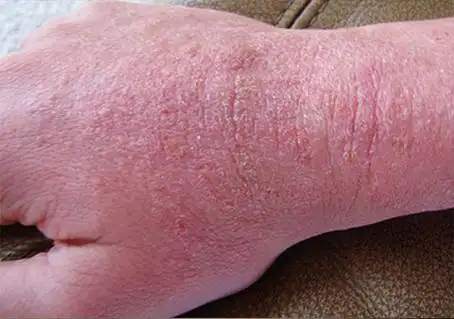 皮肤病种类湿疹症状图片