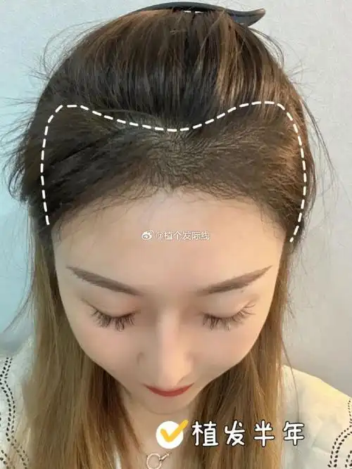【粉丝案例分享】#南京植发##毛发移植#  头发情况:额角发际线m秃