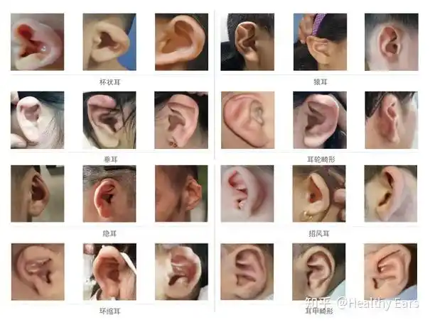 错过矫正时间窗宝宝出生后,应及时检查耳朵形态是否健康,如果出现下面