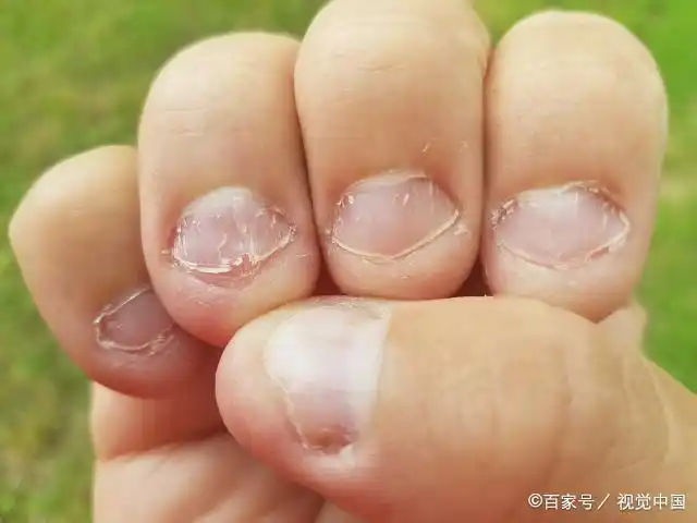 从小习惯"啃指甲"的孩子,十年后状态如何?结局让人心疼又深思