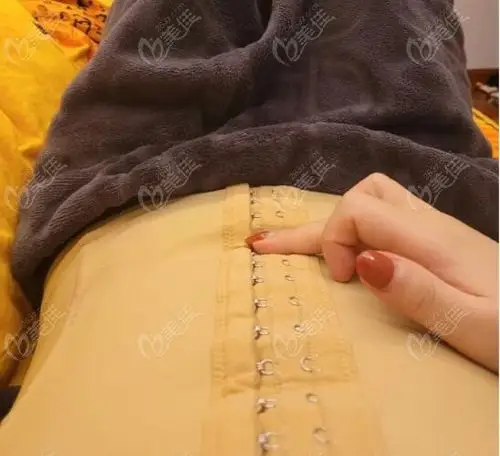 腰腹环吸1-7天真实感受