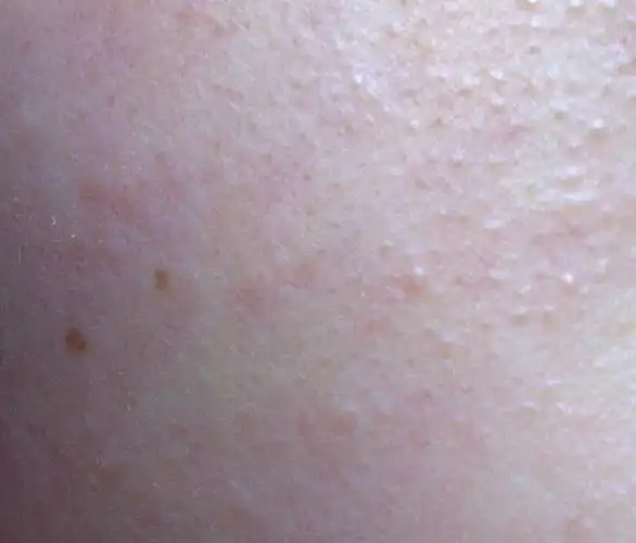 它不痛不痒的,就是那种小颗粒!要用什么药吗?