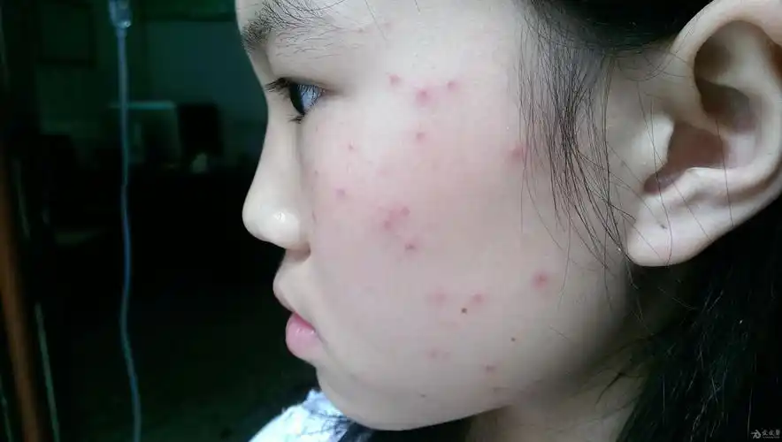 求助高手分析下这几张皮肤病图片看什么在线等