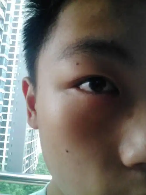 眼睛下面的袋肿了,有点疼,是不是跟前几天天天玩手机电脑有关系?