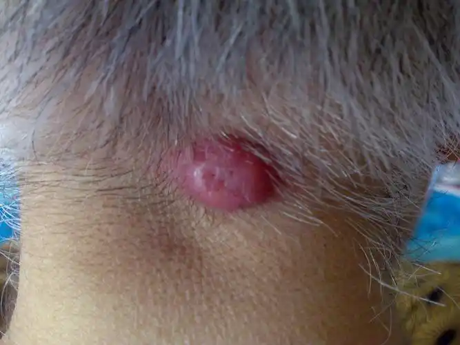 老人脖子后面起个红包,请问是怎么回事