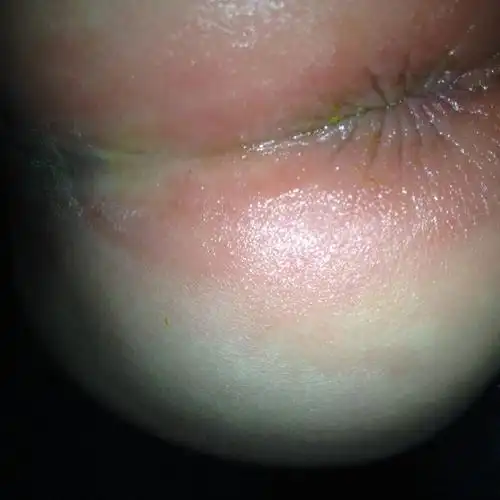 我家宝宝拉肚子拉的厉害是绿色的 肛门还不能碰 痛该怎么办 有宝妈有