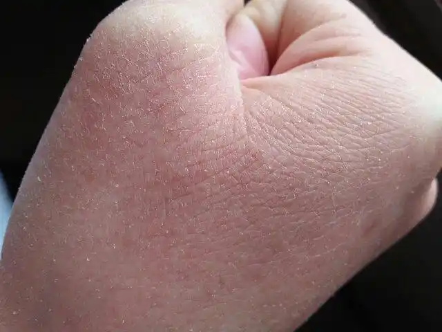 手皮肤干燥,疼痛是怎么啦,怎么办